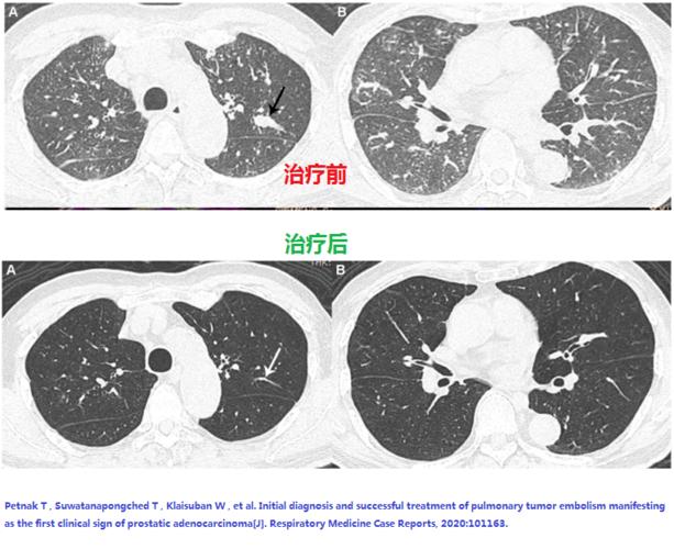 肺部理纹增多左上肺有斑点怎么办？为什么肺会出现斑点呢呢