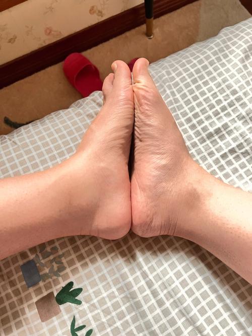 尿毒症患者透析后脚踝仍有浮肿怎么办？透析后脚为什么会肿呢呢