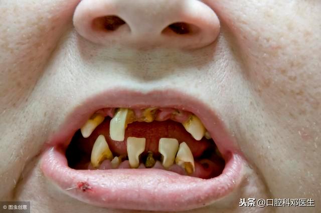 为什么拔牙的地方不疼旁边上下的几粒牙齿疼的要死？为什么整套牙齿会疼呢呢