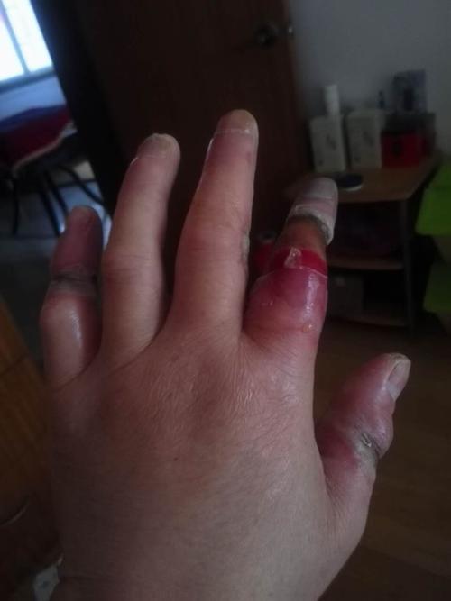 手指割伤了为什么手指发麻发热？为什么手会那么麻呢呢