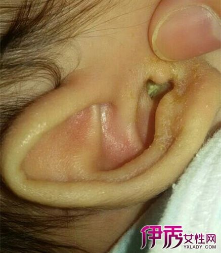 小儿中耳炎，发热最高38度5严重不？中耳炎为什么发烧呢呢
