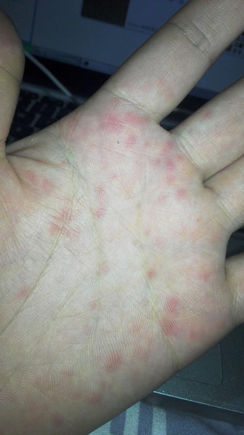 手心发红疹，是什么原因呢？为什么手掌心会红呢呢