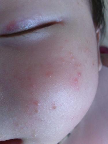 人的脸上为什么会长痘痘？为什么宝宝会长痘痘呢呢