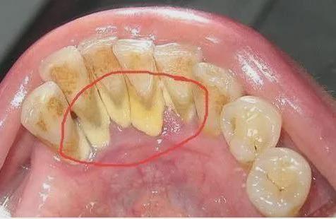 牙上为什么会长结石呢？牙为什么会有牙结石呢呢