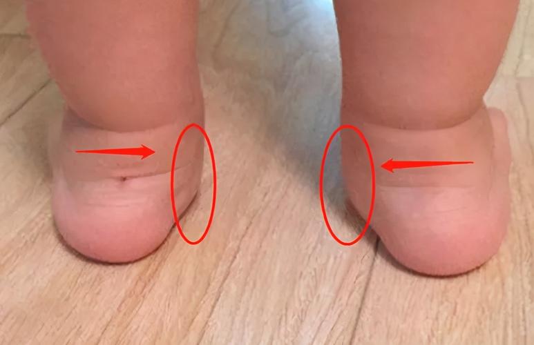 为什么一个脚是正的一个脚是歪的？为什么婴儿脚会弯呢呢