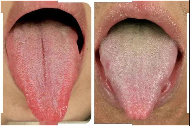 舌尖麻木是怎么回事？为什么舌头尖会发麻呢呢-图3