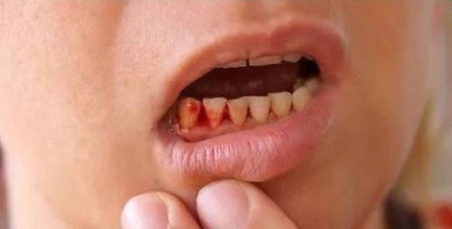 晚上牙龈总出血是怎么回事？为什么牙齿晚上更痛呢呢