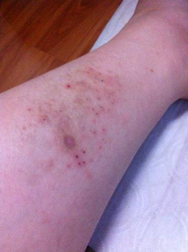 一到夏天腿上就长湿疹怎么办？为什么夏天要长湿疹呢呢