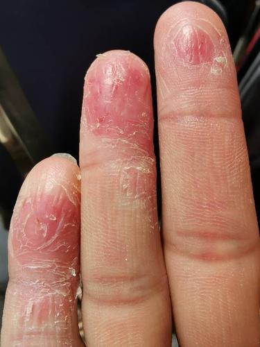 手指脱皮的原因及治疗方法？人手上为什么会脱皮呢呢