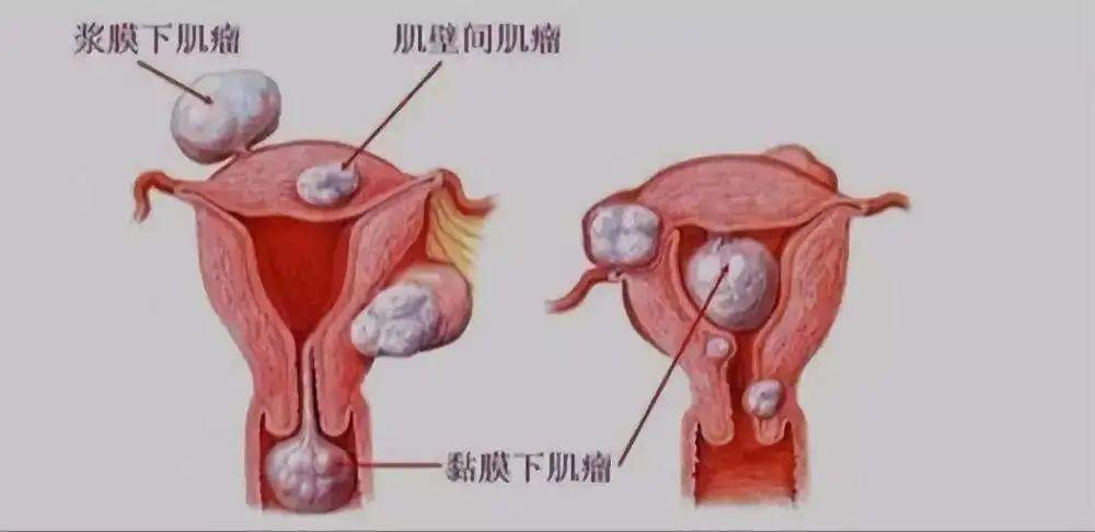 子宫囊肿是什么原因引起的啊？女人为什么会长囊肿呢呢