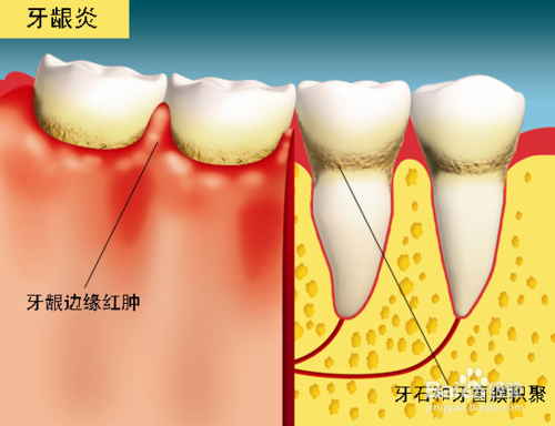 长期牙龈肿痛、出血是什么原因？牙龈为什么反复发炎呢呢-图2