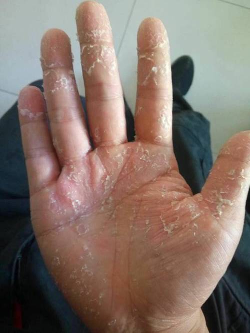 手脱皮是什么原因，手脱皮最佳治疗方法？请问手为什么要脱皮呢呢