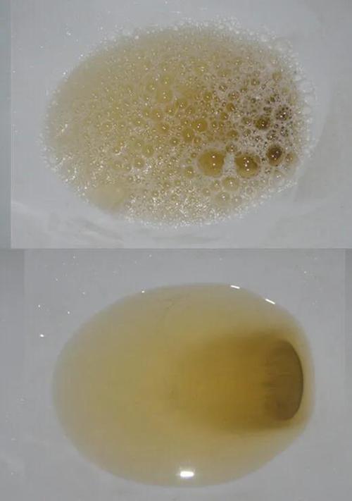 尿液里有很少很小的泡泡不消怎么回事？为什么尿里会有泡沫呢呢-图3