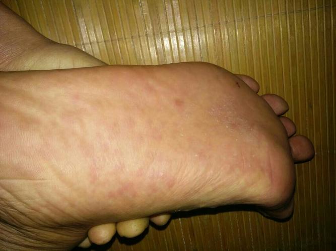 脚底有些发红痒是怎么回事？为什么脚板心总是痒呢呢