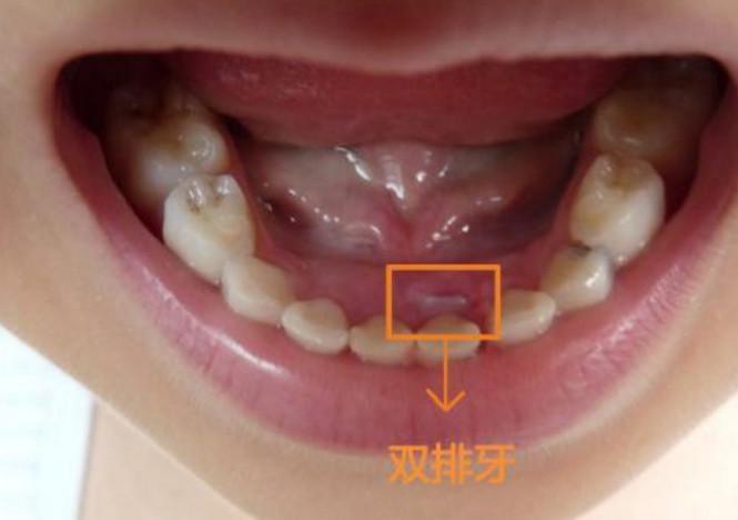 宝宝5个月长牙正常吗?刚开始长的是上边的牙齿还是下边的呢？为什么我们要长牙齿呢呢