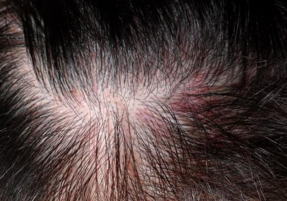 烫发染发后头皮头顶疼涨并有压迫感是怎么回事？头皮为什么硬肿呢红呢