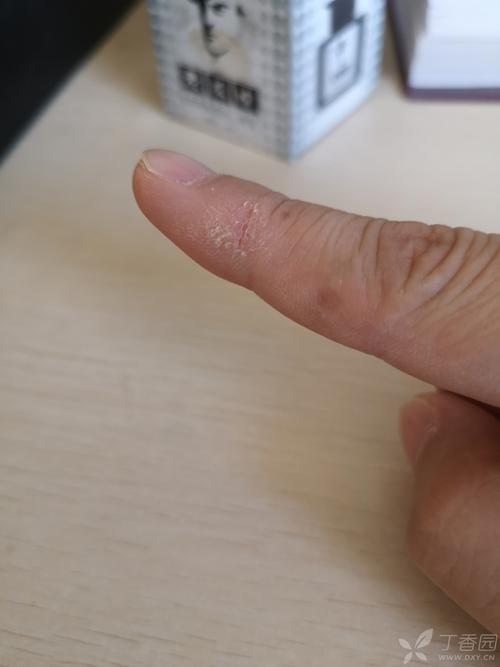 手指经常脱皮是什么原因？为什么食指老脱皮呢