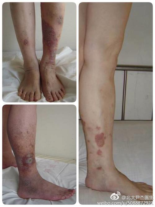 小腿皮炎湿疹怎么治？为什么小腿总长湿疹呢