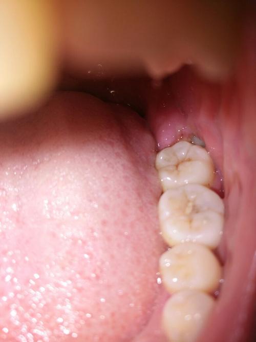 长智齿，牙齿不痛，旁边的牙龈痛？为什么智齿周边肉痛呢-图3