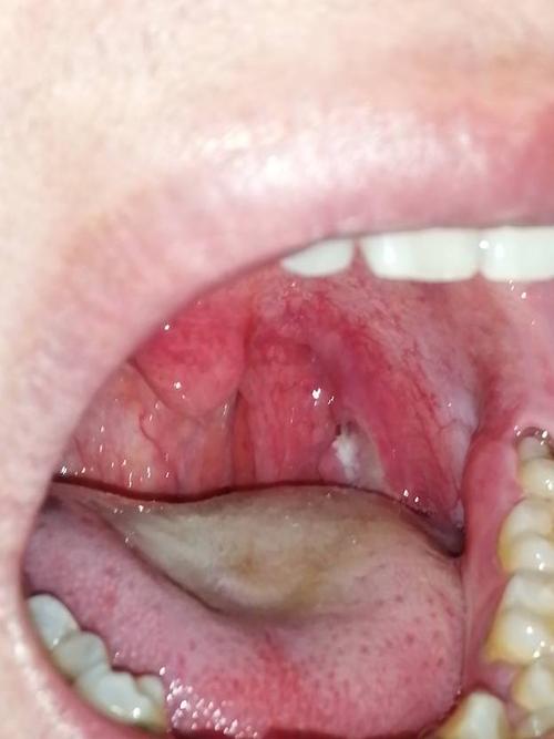 我的舌头肿胀是什么原因？为什么总是舌头肿痛呢-图2