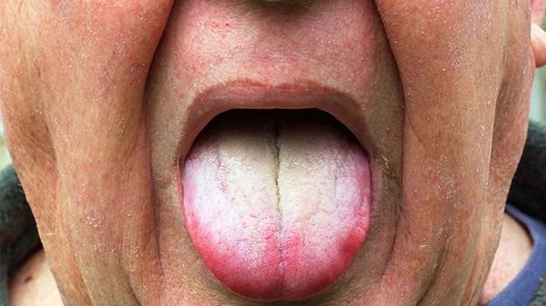 舌苔发白是怎么回事？为什么舌头后面发白呢