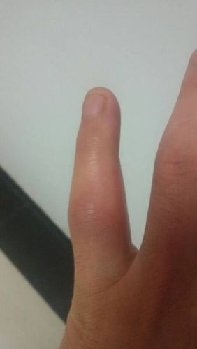 小拇指关节肿痛是什么原因引起的？为什么关节有点肿呢-图2
