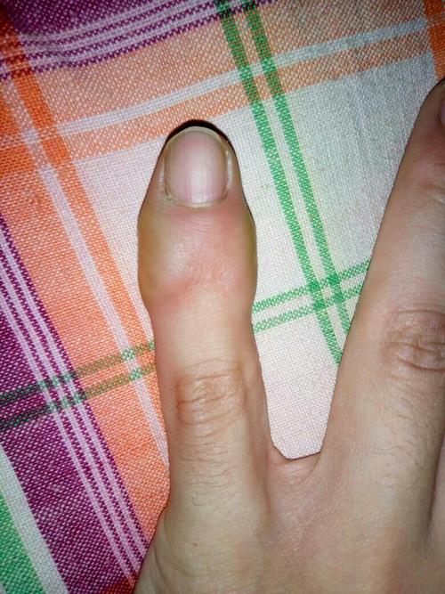 小拇指关节肿痛是什么原因引起的？为什么关节有点肿呢-图1