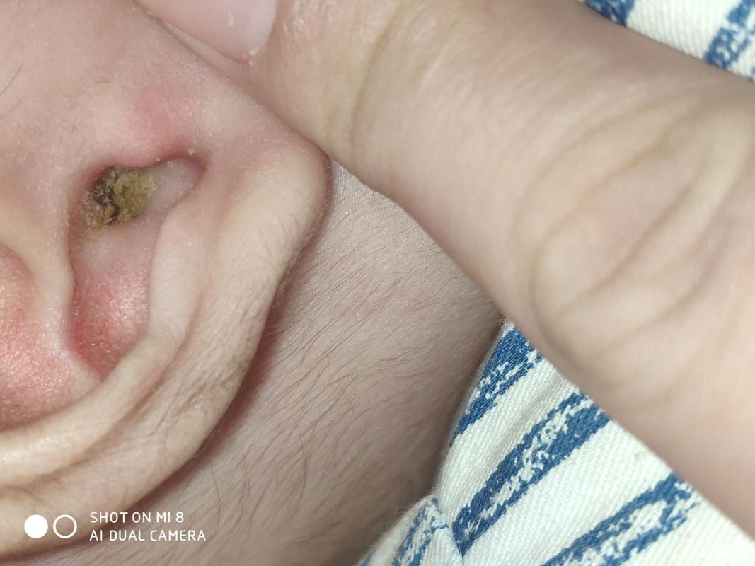 宝宝耳朵的硬块耳屎可以用油或者什么液体来软化呢？为什么要软化耳朵呢