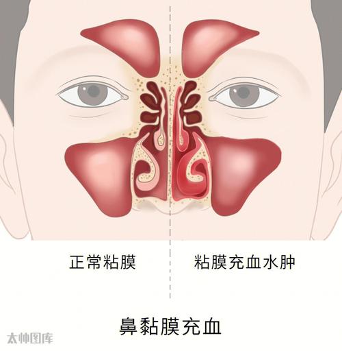 右边鼻孔经常流鼻血是什么原因？为什么经常右边鼻塞呢