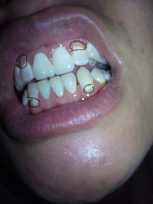 牙齿上有洞是怎么回事？补牙为什么会有大洞呢