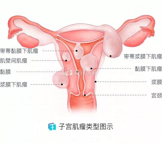 子宫肌瘤一般由哪些原因引起的？为什么妇科会长肌瘤呢