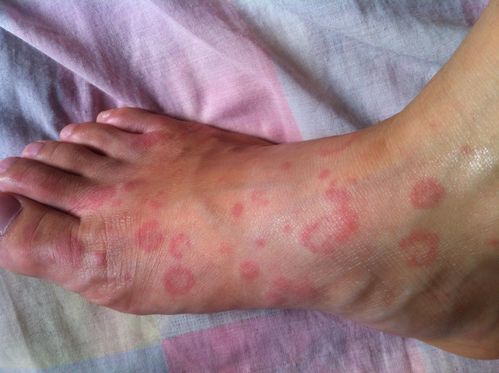 脚上长的大红斑是什么原因？为什么脚会生红斑呢-图1