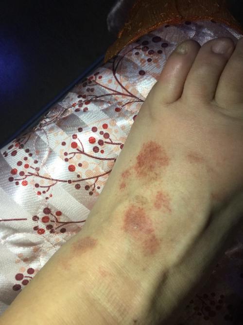 脚上长的大红斑是什么原因？为什么脚会生红斑呢-图2