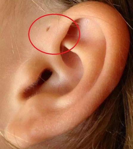 耳朵上有小孔怎么回事？耳朵为什么会长小洞呢