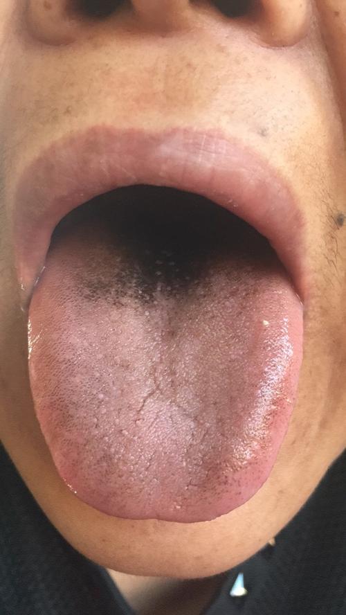舌苔发黑是什么病？请问舌头为什么发黑呢