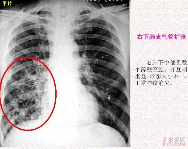 右肺上叶后端不典型支气管扩张，并周围少许炎症？为什么右肺也有炎症呢