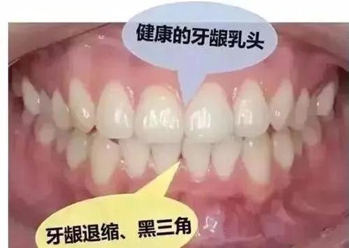 牙缝很大怎么补救？为什么牙缝会增大呢-图2