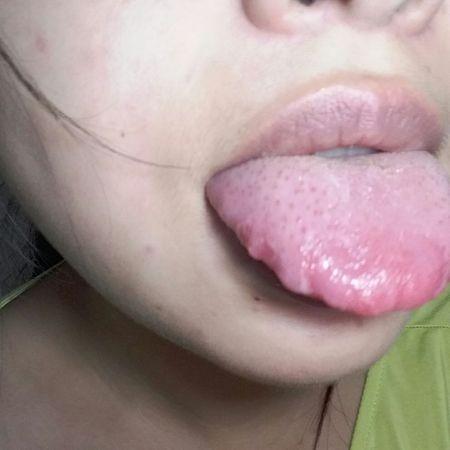 舌头中间老感觉发烫有时候像针扎一样疼？为什么舌尖很刺痛呢