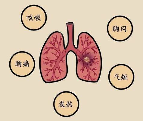 肺上的炎症怎么消？为什么肺部有点炎症呢