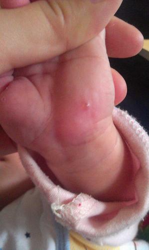1岁11个月宝宝被蚊子咬后肿的很大有很多水泡怎么回事？蚊子为什么会起泡呢-图3