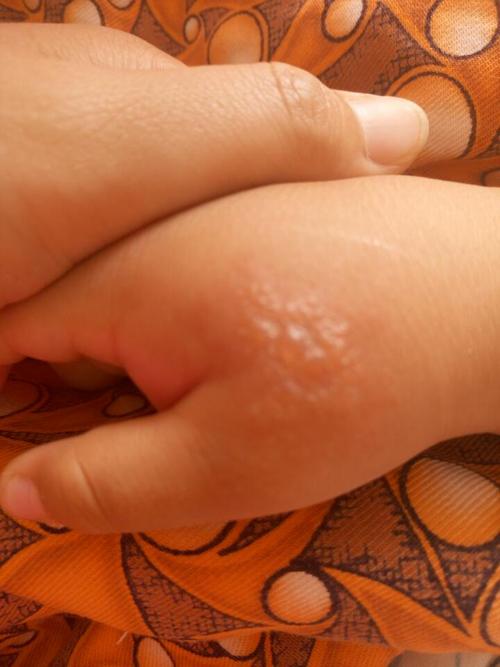 1岁11个月宝宝被蚊子咬后肿的很大有很多水泡怎么回事？蚊子为什么会起泡呢-图1