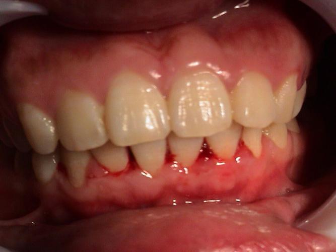 牙龈出血，关节酸痛？为什么牙龈很酸痛呢