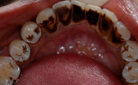 牙结石是怎样形成的？牙为什么会有牙菌斑呢-图3