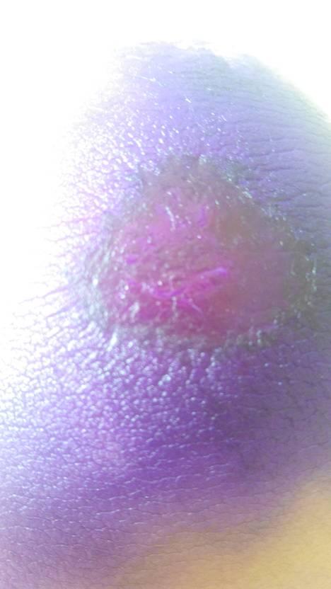 膝盖碰到了地板上出现了紫色的肉疼怎么缓解？为什么膝盖会紫呢