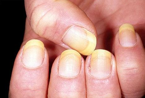 肝病与指甲的关系？肝炎为什么手心发黄呢