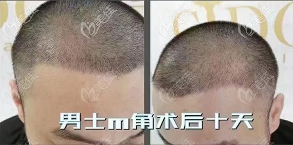 温州种植头发哪家好？(哪里植头发好)-图2