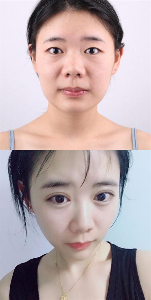 上海哪家医院做双眼皮手术好？(上海割双眼皮哪里好？)-图2
