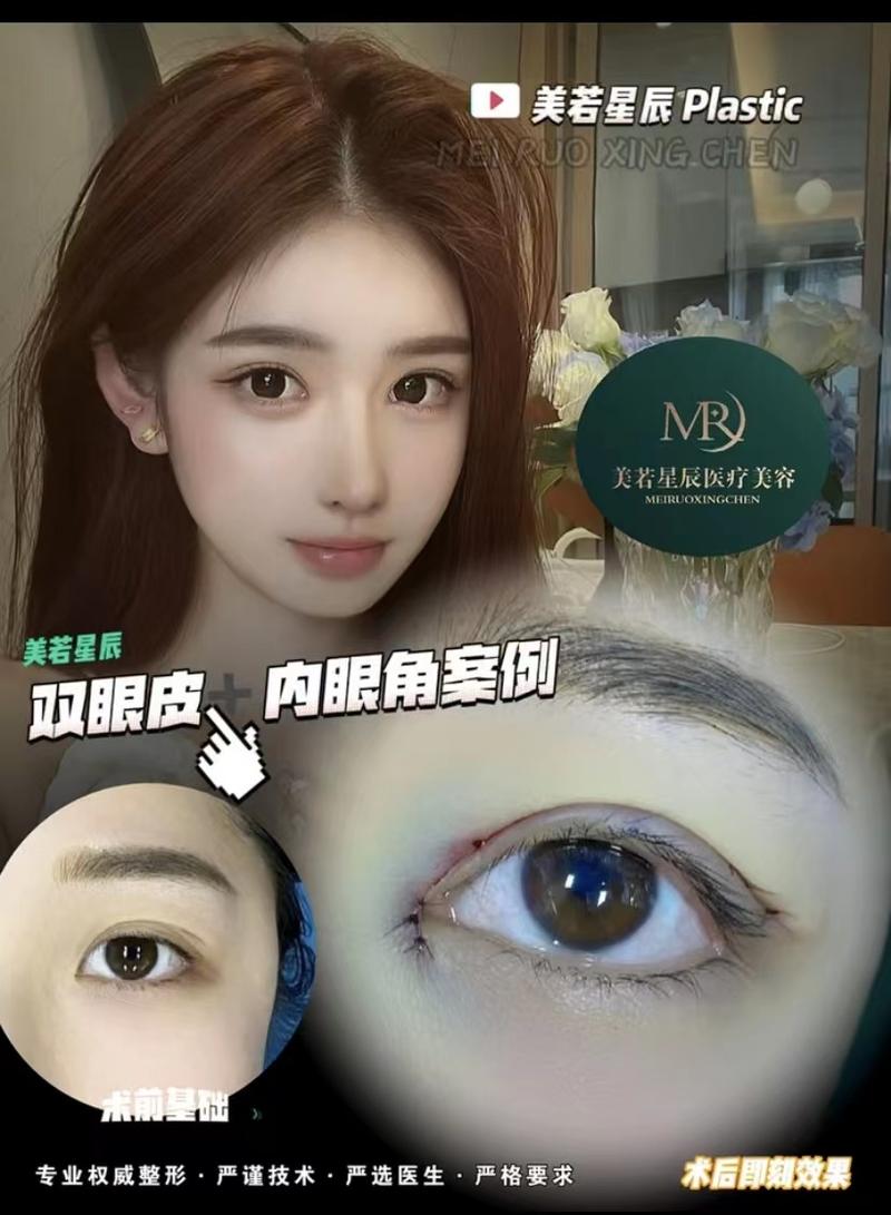 上海哪家医院做双眼皮手术好？(上海割双眼皮哪里好？)-图3