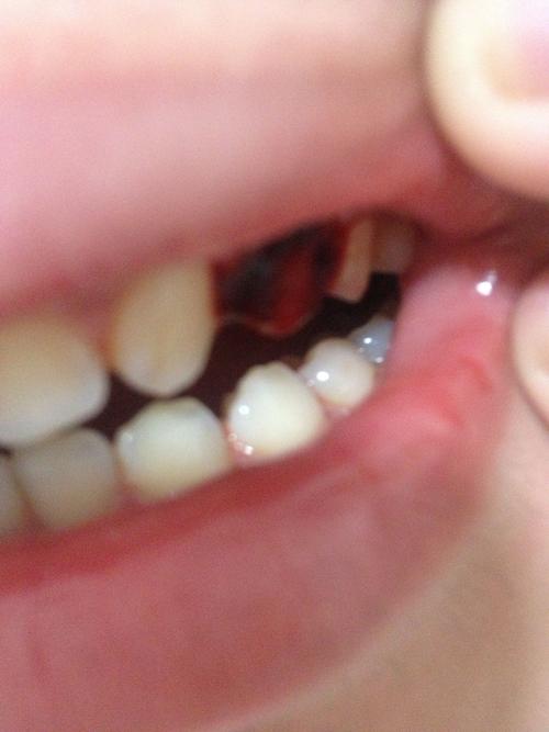 牙出血怎么办？牙齿为什么会出血呢