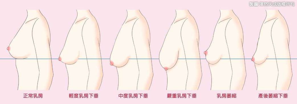 乳房忽然松软是什么原因？女人乳房软为什么呢